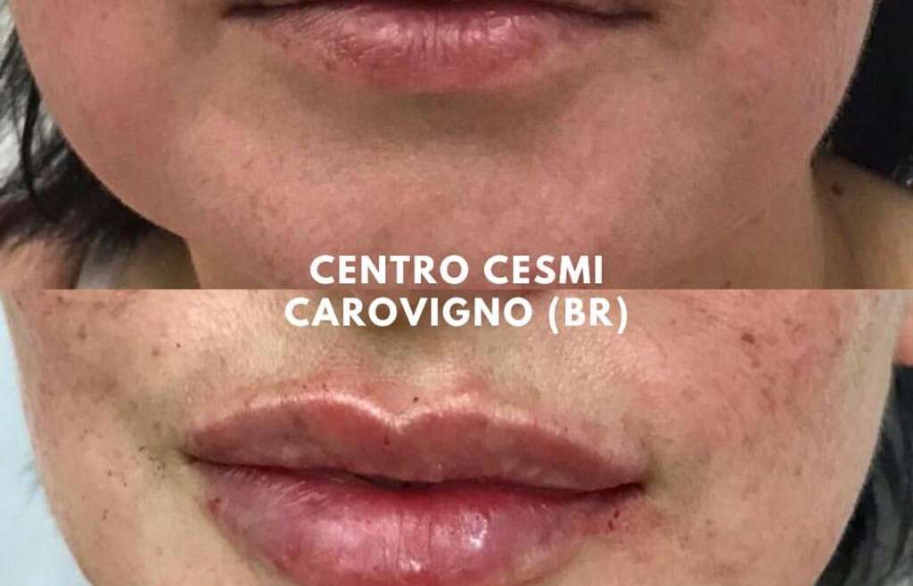 LIP FILLER
