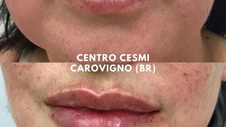 LIP FILLER